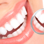 Tipos de clareamento dental